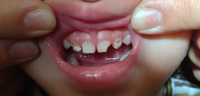 Que faire si un enfant a mal aux dents: comment anesthésier?