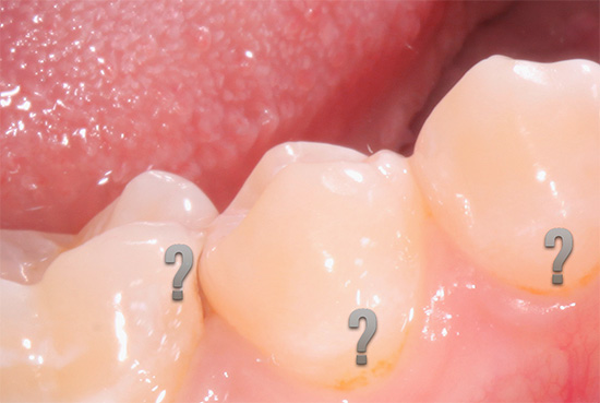 Parlons des caractéristiques de la carie dentaire cachée, de son apparence et de ce qui est potentiellement dangereux ...