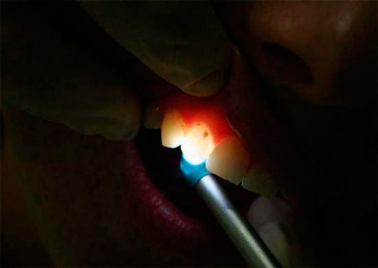 La transillumination comme méthode de diagnostic des caries latentes consiste à éclairer la dent avec une lumière vive, tandis que les zones carieuses peuvent être facilement détectées en raison de leur plus faible transparence.