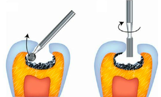 Un exemple de préparation de cavités dans la région de la fissure de la dent