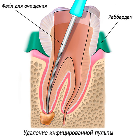 La photo montre schématiquement le nettoyage des canaux dentaires