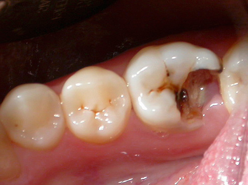 On dirait une dent cariée par la carie avant le traitement