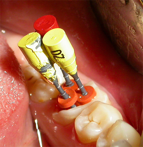 Il est important de nettoyer et d'antiseptique complètement chaque canal de la dent
