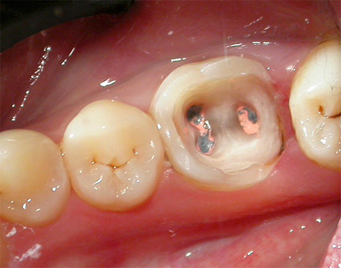 Et c'est à cela que ressemble la dent après la procédure de dépulpation, mais avec la languette du moignon toujours pas réglée.