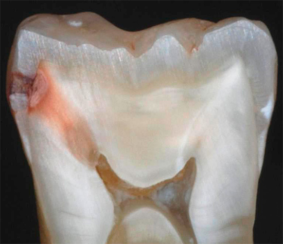 La photo montre un exemple de ce à quoi ressemble une carie cachée sur une coupe d'une vraie dent: auparavant, la région carieuse était cachée au point de contact des dents voisines et n'a rien révélé.