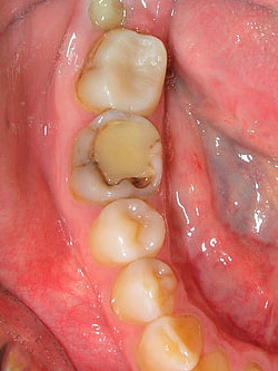 Le processus carieux peut se développer à la fois sous le remplissage et au bord de son ajustement à la dent