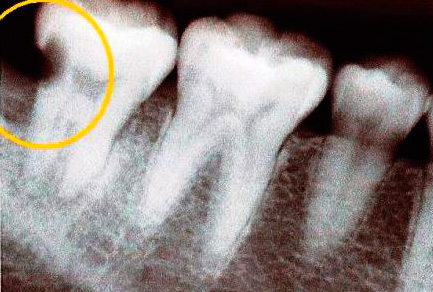 Sur la radiographie, une cavité carieuse de la dent est clairement visible.
