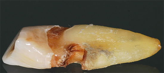 La photo montre un exemple lorsque des caries cachées dans la zone de la racine de la dent ont finalement conduit à la retirer.