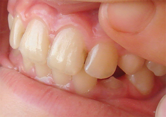 Le processus carieux dans la région interdentaire peut capturer les deux dents à la fois.