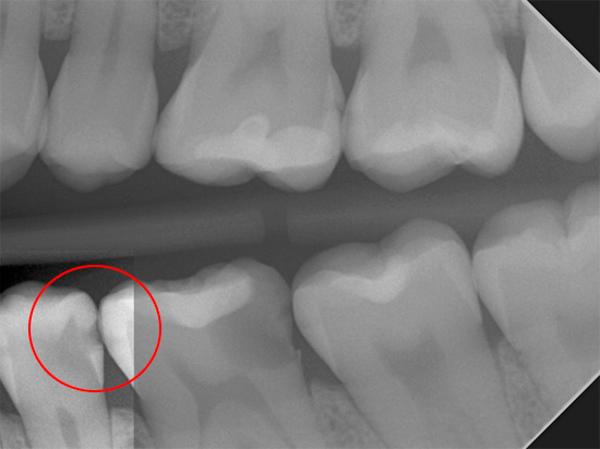 تظهر الأشعة السينية بوضوح تسوس الأسنان بواسطة التسوس العميق ، والذي سيكون غير مرئي من خلال فحص بصري بسيط.
