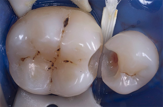 وهكذا تبدو الأسنان نفسها مع تجويف مشكل بالفعل تحت الختم.