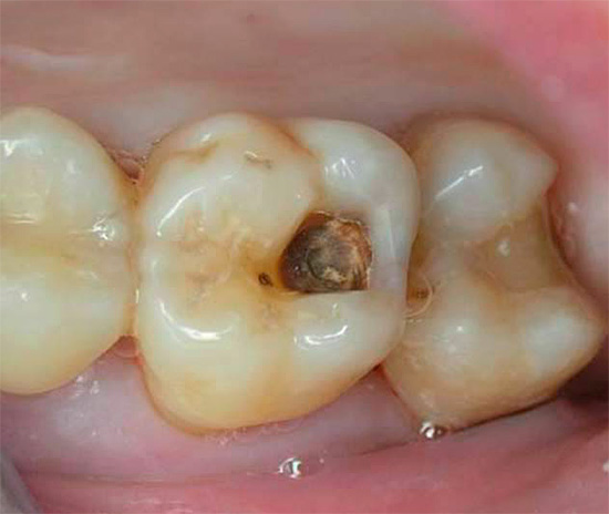 في حالات التسوس العميق المزمن ، على الرغم من تسوس الأسنان الواسع النطاق ، قد لا يحدث الألم في بعض الأحيان على الإطلاق.