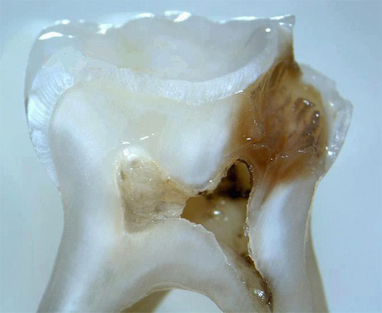 شريحة من الأسنان الحقيقية مع تجويف عميق ، تصل تقريبًا إلى حجرة اللب.
