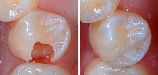 À gauche sur la photo, une dent avec une cavité formée et à droite - une vue après l'installation du joint.
