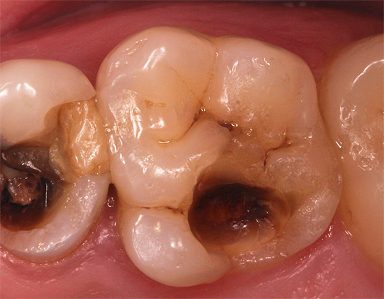 Les matériaux d'obturation précédemment utilisés suggéraient l'excision d'une quantité importante de tissus dentaires durs pour une rétention fiable de l'obturation.
