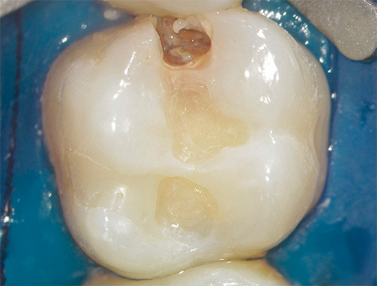 L'apparition de matériaux d'obturation modernes a considérablement réduit le volume de tissu dentaire excisé dans le traitement des caries.