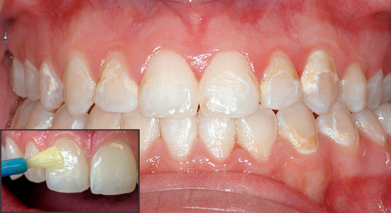 La thérapie reminéralisante vous permet de saturer l'émail des dents avec des composants minéraux et ainsi restaurer ses propriétés d'origine.