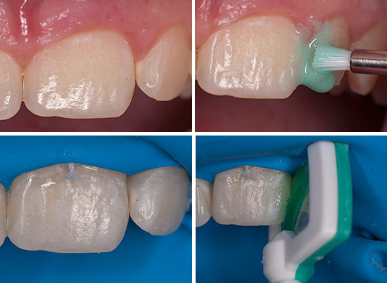Premières étapes du traitement dentaire utilisant la technologie ICON