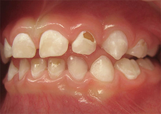 Si le traitement n'est pas commencé à temps, le processus de destruction affecte progressivement les tissus profonds de la dent ...