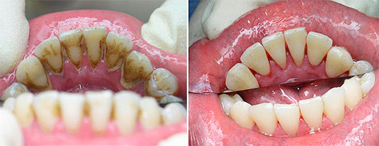 Avant la procédure de traitement, la plaque dentaire et les dépôts minéraux sont retirés de la dent malade (et parfois de tous).