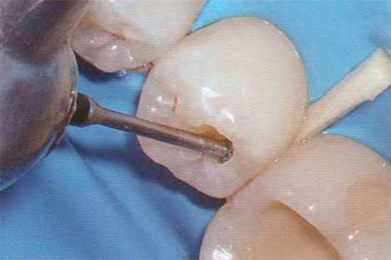 Une étape importante de la procédure est la préparation de la dent, au cours de laquelle les tissus infectés et pigmentés sont retirés.
