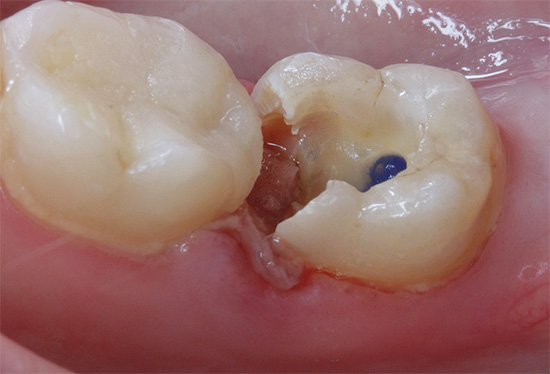Voici à quoi ressemble la dent au début de la procédure de traitement - un matériau dévitalisant est visible à l'embouchure du canal radiculaire.