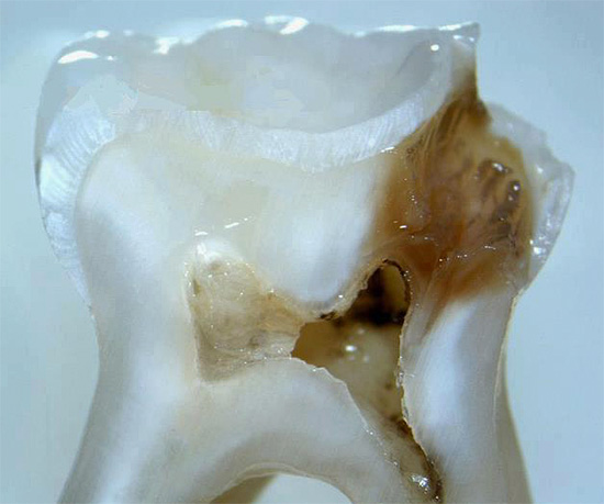 On peut voir dans la section que la cavité carieuse s'est rapprochée de la chambre pulpaire de la dent.