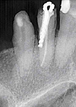 La radiographie montre un exemple de perforation d'une racine dentaire.
