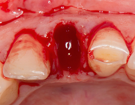 Les saignements alvéolés prolongés ont toujours leurs causes, qu'il était souhaitable d'identifier même avant l'extraction dentaire.