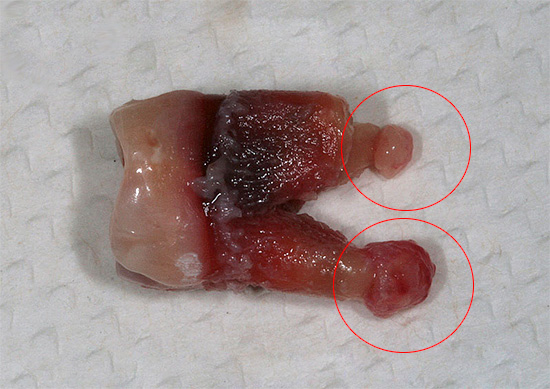 La photo montre une dent avec des kystes sur les racines - si un morceau d'une telle racine reste dans le trou, le patient peut développer une complication grave ...