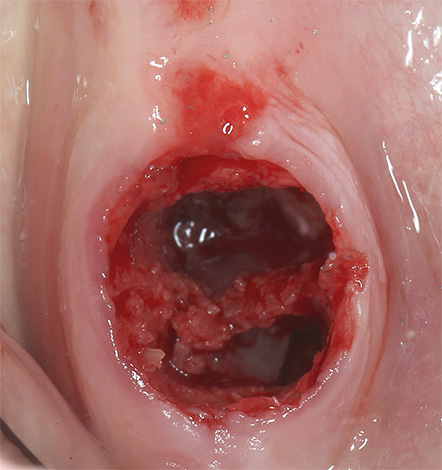 Avec la suppuration du trou dentaire, une alvéolite se développe