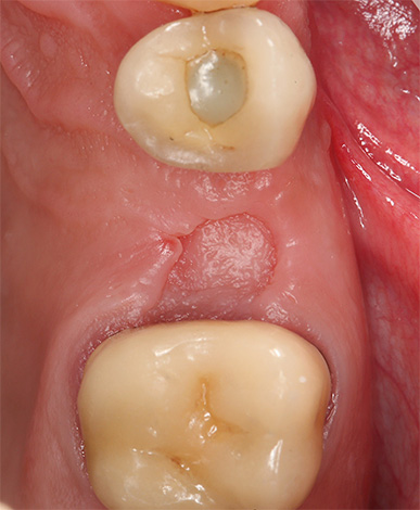 Photographie d'un trou dentaire guéri