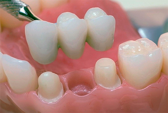 Un tel bridge permet de restaurer les fonctions d'une dent perdue et d'éviter à l'avenir une malocclusion.