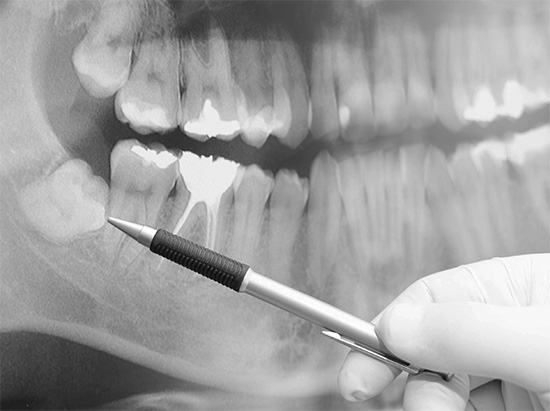 Bilgelik dişlerini çenede standart olmayan konumlarından dolayı çıkarmak, artan karmaşıklığın bir operasyonu olarak kabul edilir.