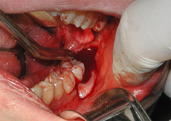 Bazen, diş çekimi sırasında, doktor dişeti dokusunu çok ciddi şekilde yaralar, bu da ek olarak kanamaya katkıda bulunur.