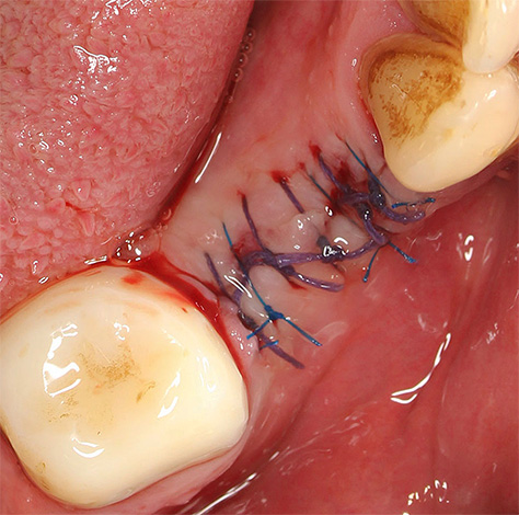 Des sutures peuvent être placées sur les bords de l'alvéole dentaire.