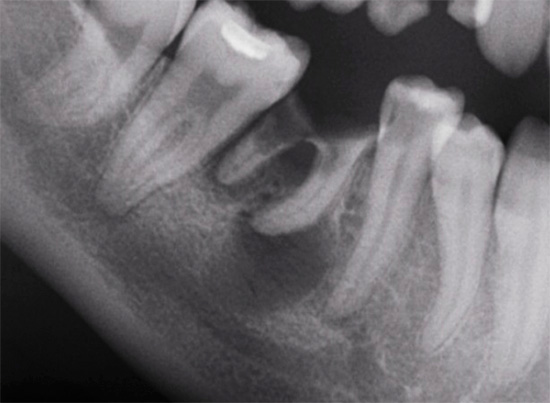 Voici à quoi ressemble la parodontite sur une radiographie (radiographie)