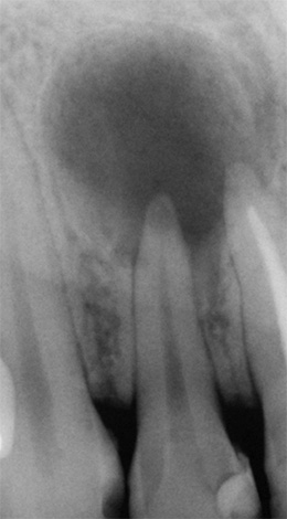 Une tache sombre dans l'image est un signe de parodontite.
