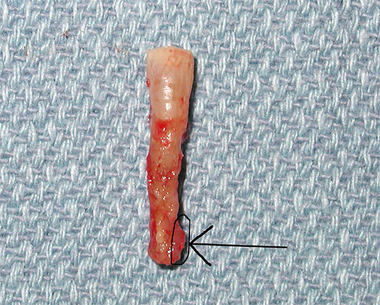 La photo montre une dent avec un kyste à la racine.