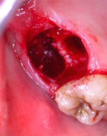 Un problème assez grave qui survient parfois après l'extraction d'une dent est également l'alvéolite - inflammation des parois du trou.