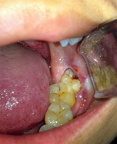 La photo montre une dent de sagesse inférieure affectée par des caries profondes, dont une partie est cachée sous la gencive.