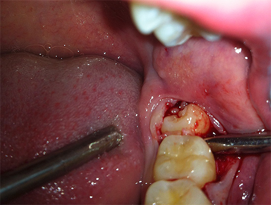 Dans la plupart des cas, les huitièmes dents inférieures sont beaucoup plus difficiles à retirer que les huit sur la mâchoire supérieure.