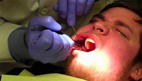 Parmi les conséquences désagréables de l’ablation d’une dent de sagesse figurent diverses erreurs médicales, notamment une fracture de la mâchoire inférieure ou une rupture des coins de la bouche du patient.