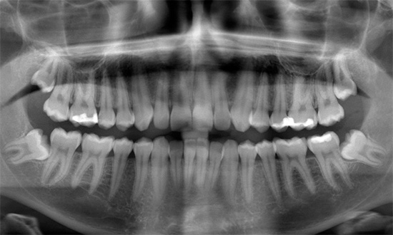 Une croissance incorrecte des dents de sagesse peut perturber considérablement la morsure.