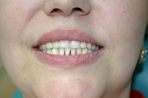 Quelqu'un n'aime pas catégoriquement les prothèses dentaires en acrylique, tandis que certains patients y répondent très positivement.