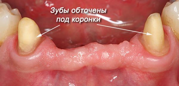 Les dents sélectionnées sous le support de la prothèse grincent généralement sous les couronnes.