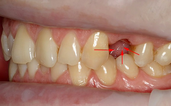 Sur la photo, les flèches indiquent la direction du déplacement des dents lorsqu'un espace vide apparaît dans leur rangée.