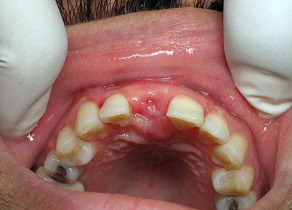 Il est hautement indésirable de se passer de prothèses des dents extraites pendant longtemps.