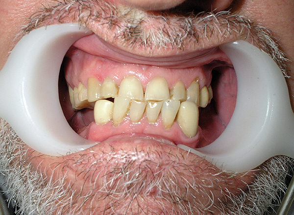 Plus les prothèses des dents manquantes sont réalisées rapidement, plus le risque de conséquences indésirables pour toute la dentition est faible.