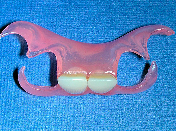 La photo montre une prothèse papillon pour les prothèses de deux dents de devant.